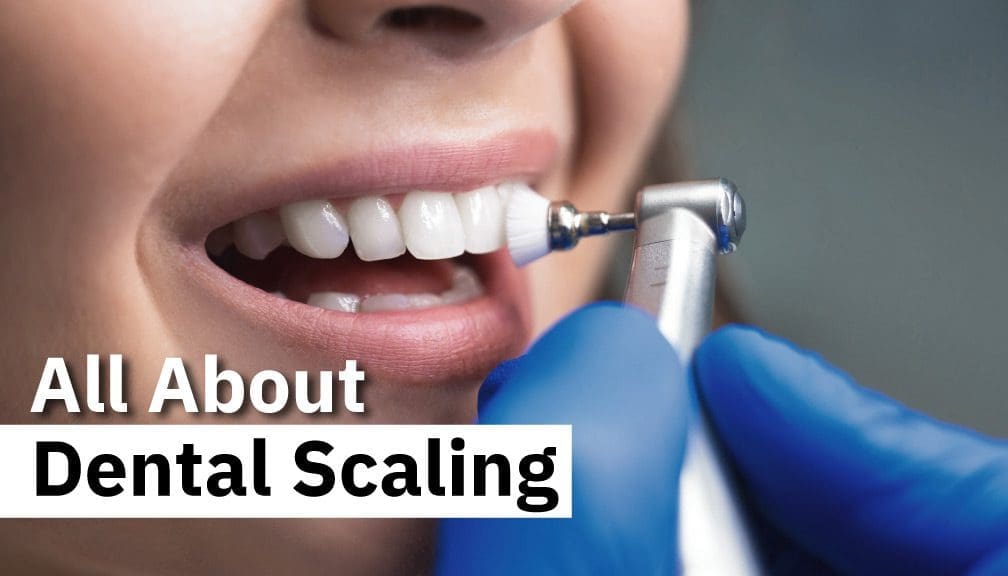 All about Dental Scaling